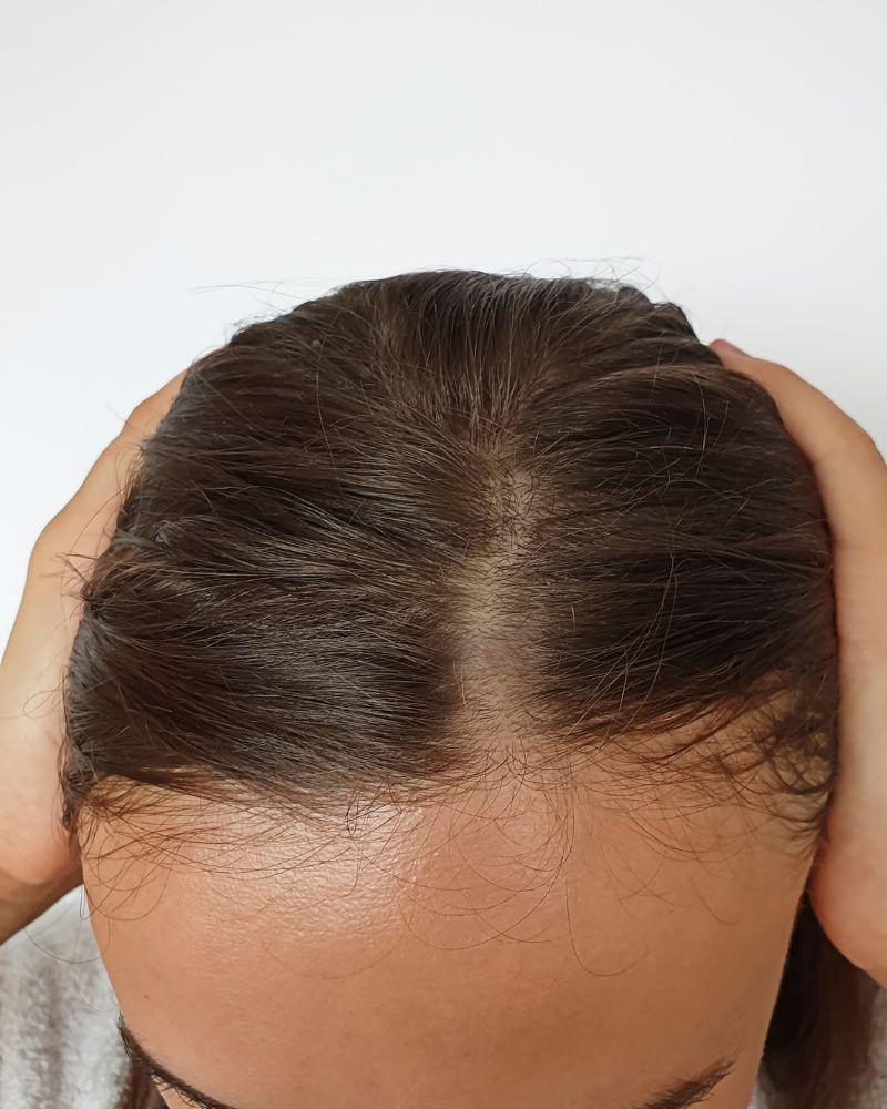 A woman receiving hair restoration treatment at Mujtaba NP Clinics, Med Spa in Corona, Queens