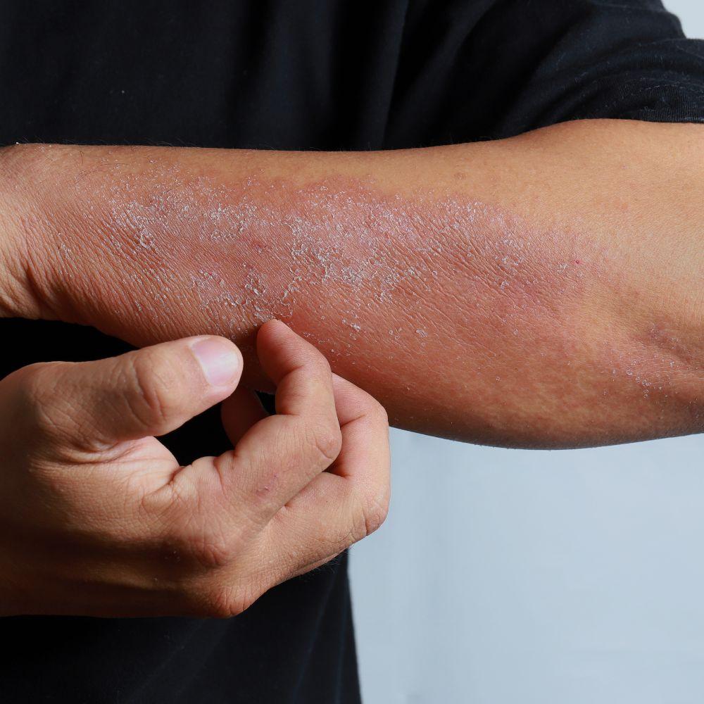 eczema skin condition