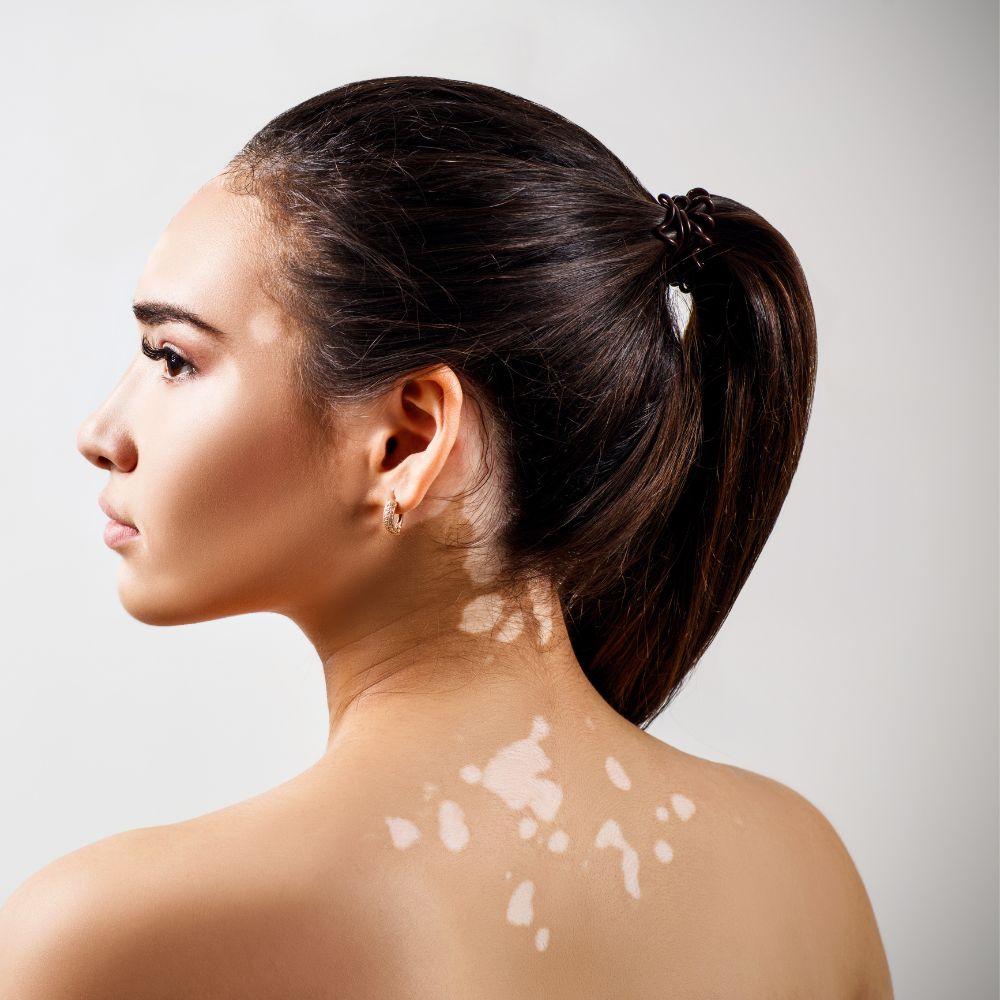 vitiligo skin condition