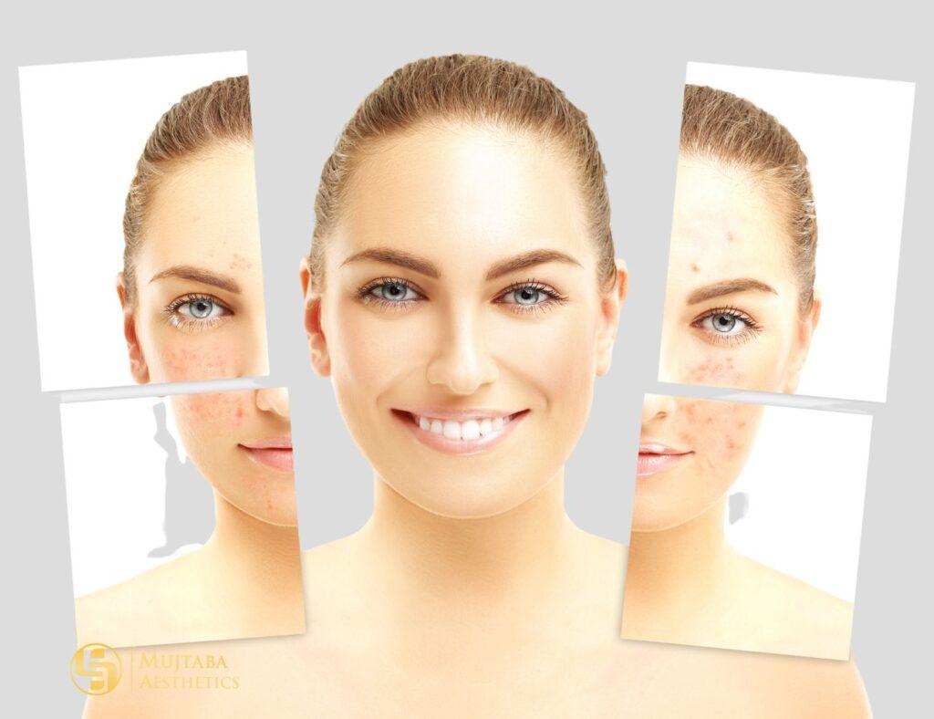 Rosacea laser therapy in NY